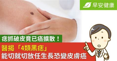 女生長痣|是痣or皮膚癌？醫「1張圖秒對照」 長這2部位最危險